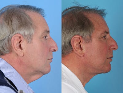 Office Facelift Before & After Gallery - Patient 129764 - Image 1