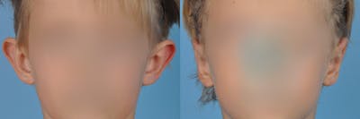 Otoplasty/Ear Pinning Before & After Gallery - Patient 278482 - Image 1