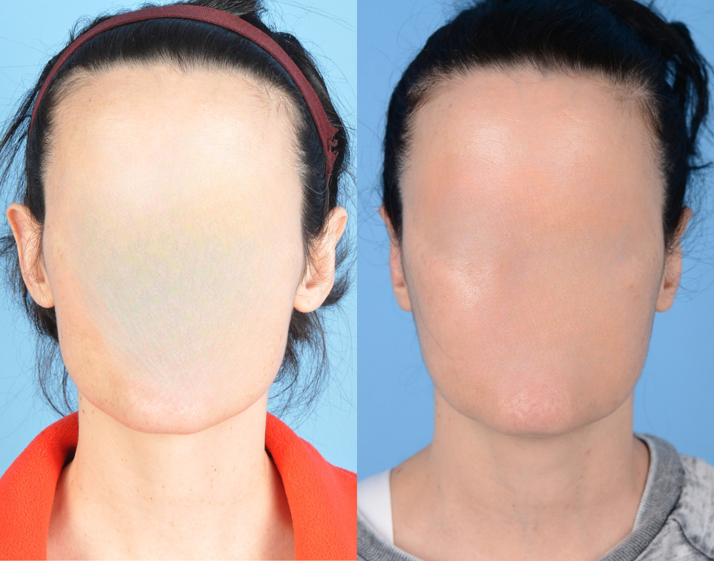 Otoplasty/Ear Pinning Before & After Gallery - Patient 346763 - Image 1