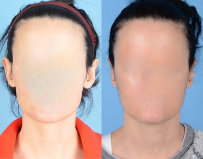 Otoplasty/Ear Pinning Before & After Gallery - Patient 346763 - Image 1