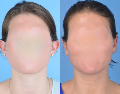 Otoplasty/Ear Pinning Before & After Gallery - Patient 189629 - Image 1