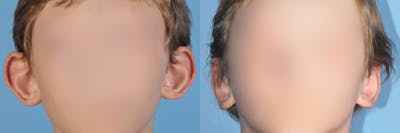 Otoplasty/Ear Pinning Before & After Gallery - Patient 266591 - Image 1