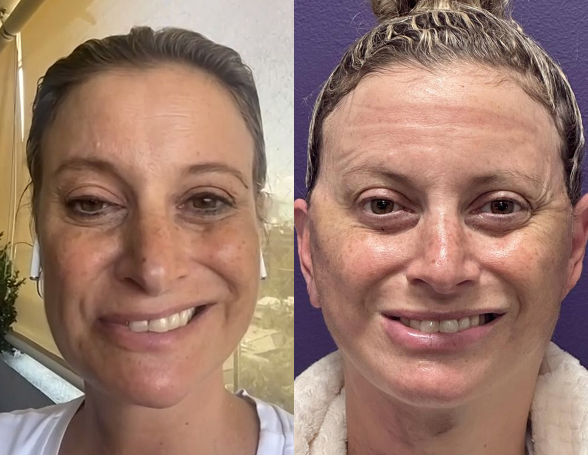 Denervation Before & After Gallery - Patient 183014 - Image 1