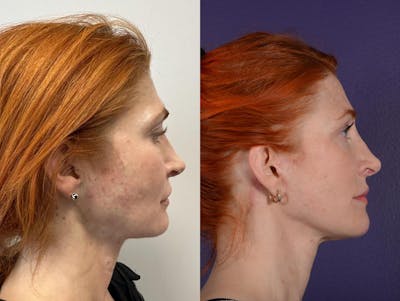 Office Facelift Before & After Gallery - Patient 253986 - Image 1