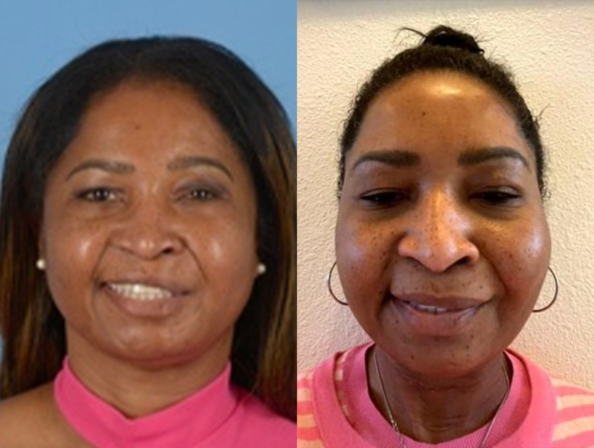 Denervation Before & After Gallery - Patient 284636 - Image 1