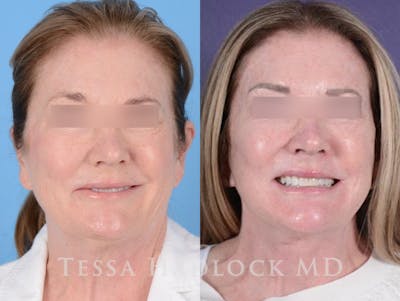 Denervation Skin Denervation Before & After Photos | Hadlock Facial Plastic Surgery