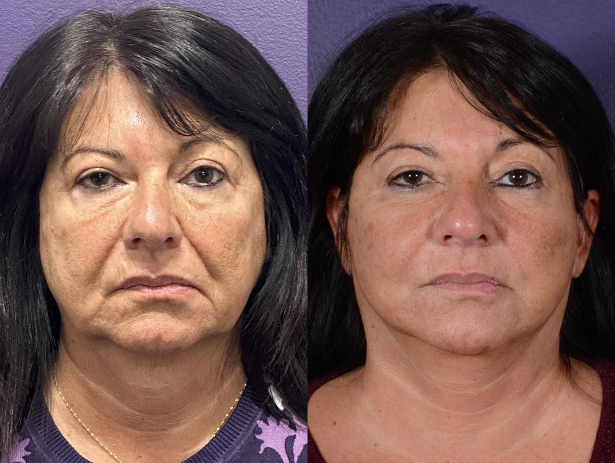 Office Facelift Before & After Gallery - Patient 304946 - Image 1