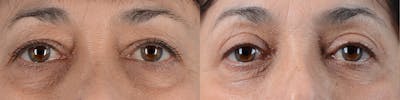 Blepharoplasty Before & After Gallery - Patient 293782 - Image 1