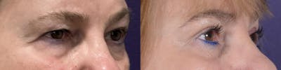 Blepharoplasty Before & After Gallery - Patient 966473 - Image 1