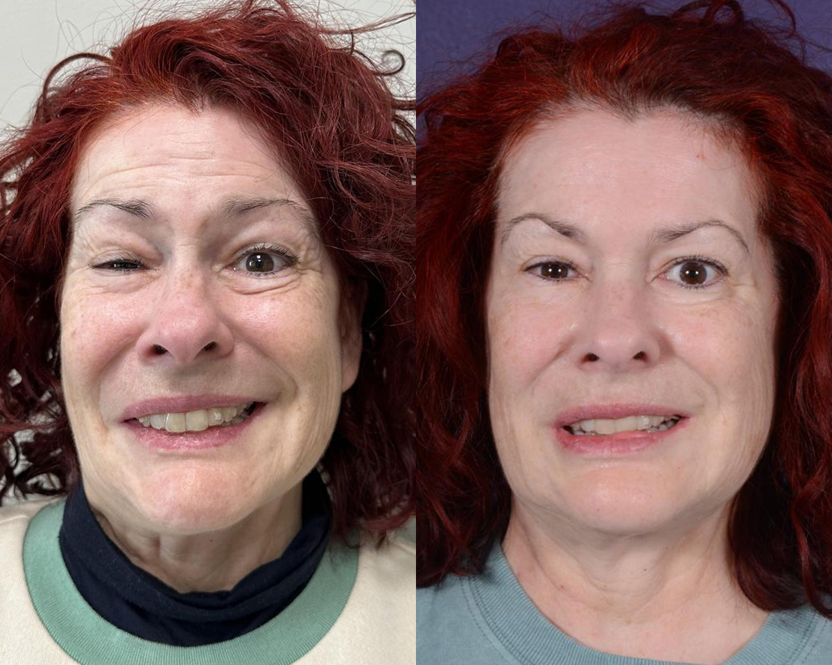 Muscle Resection: DAO, DLI, Ocular Myomectomy, Mentalis Before & After Gallery - Patient 114582 - Image 1