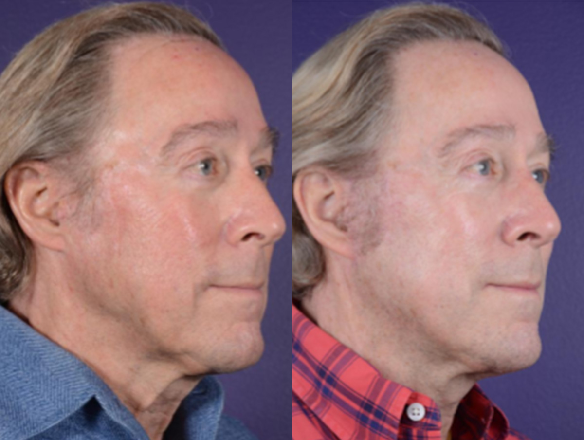 Office Facelift Before & After Gallery - Patient 396850 - Image 1