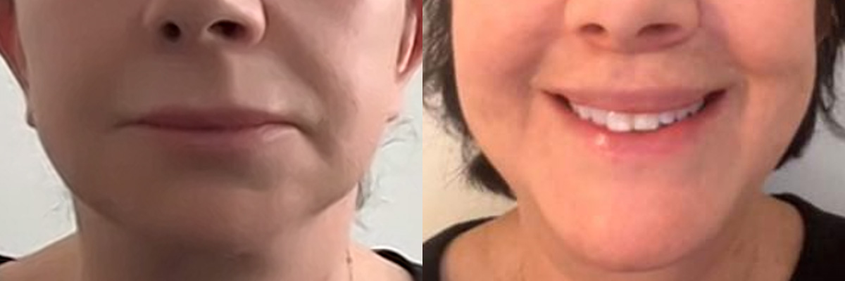 Lip Lift Before & After Gallery - Patient 191717 - Image 1