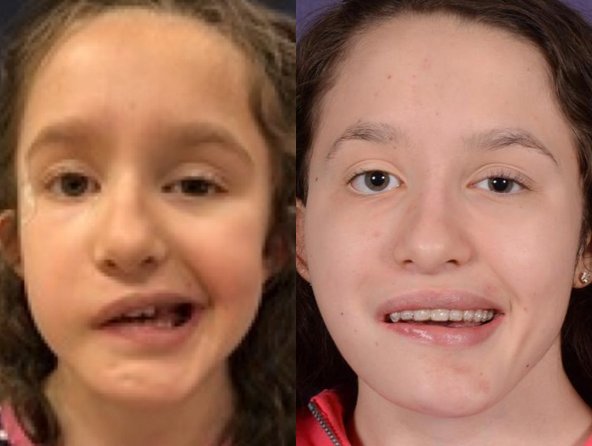 Gracilis Before & After Gallery - Patient 261745 - Image 1