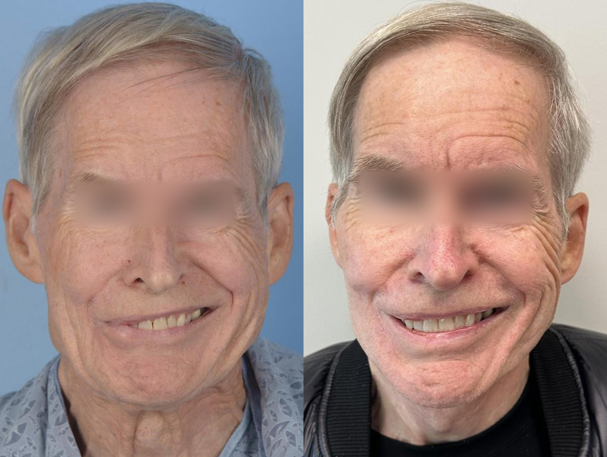 Denervation Before & After Gallery - Patient 325355 - Image 1