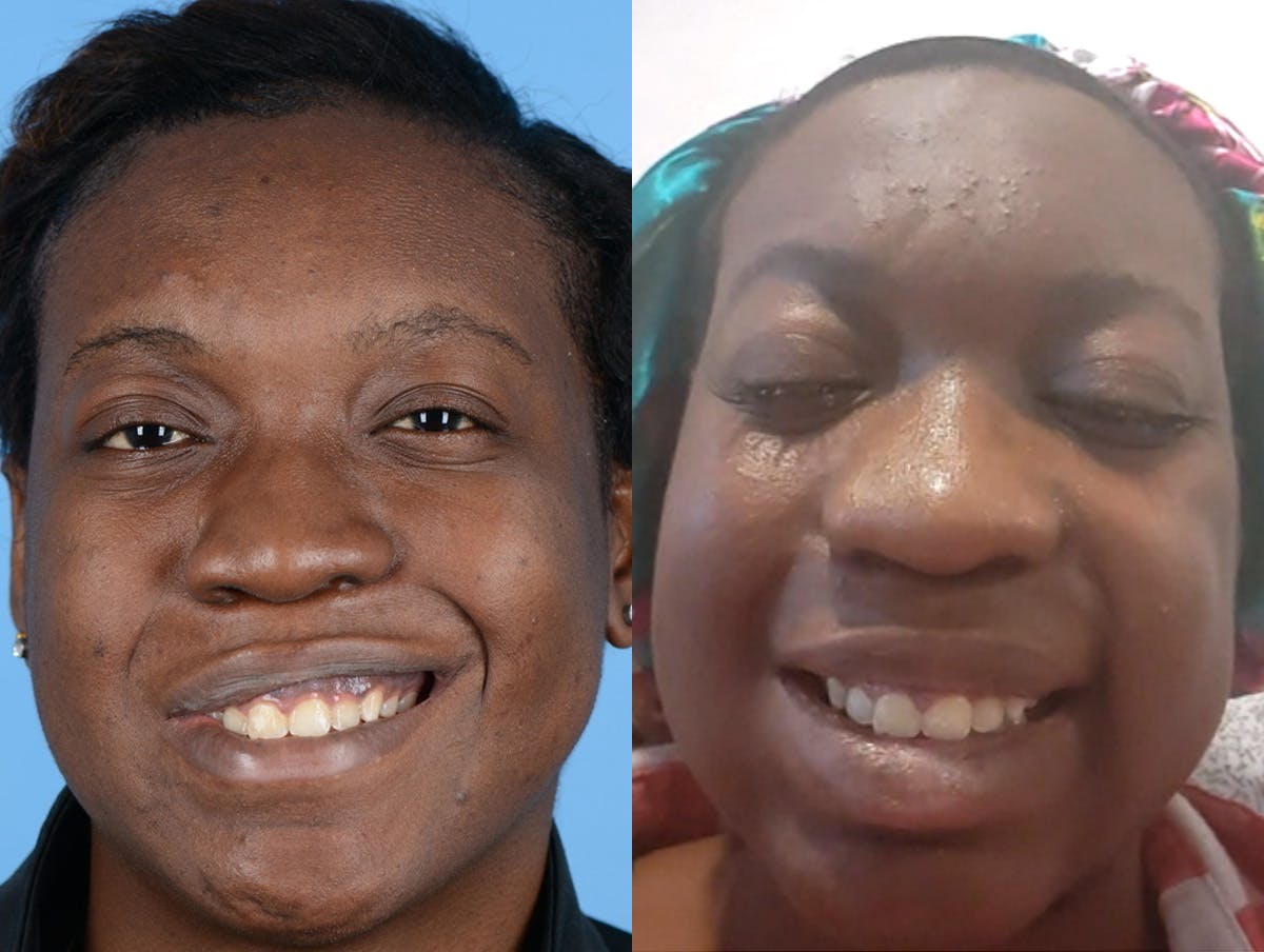 Denervation Before & After Gallery - Patient 945880 - Image 1