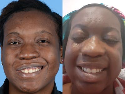 Denervation Before & After Gallery - Patient 945880 - Image 1