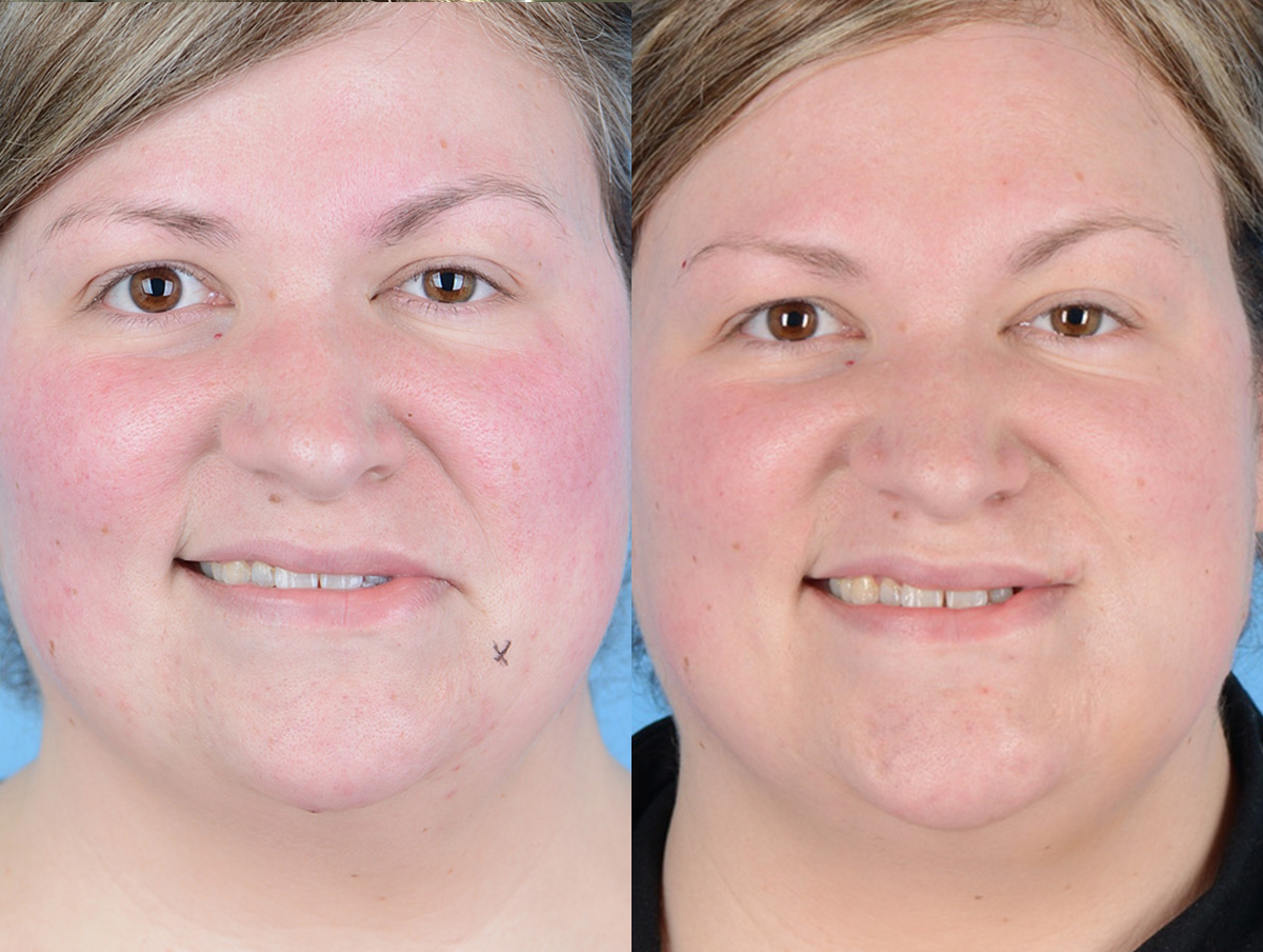 Muscle Resection: DAO, DLI, Ocular Myomectomy, Mentalis Before & After Gallery - Patient 370821 - Image 1