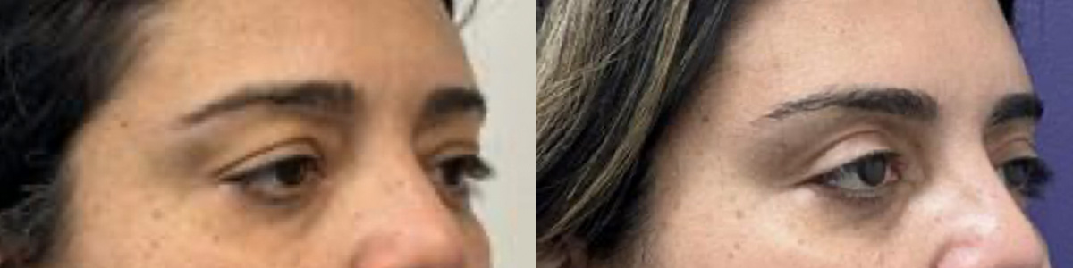 Blepharoplasty Before & After Gallery - Patient 941121 - Image 1