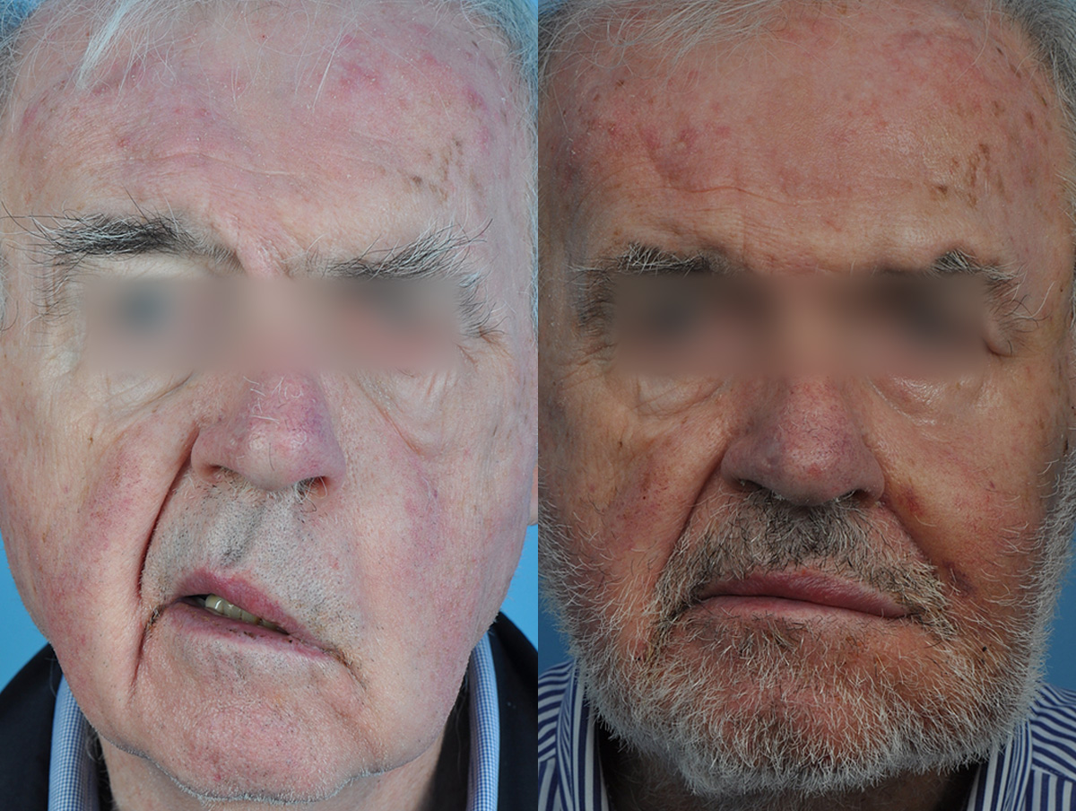 Static Suspension  Before & After Gallery - Patient 208152 - Image 1