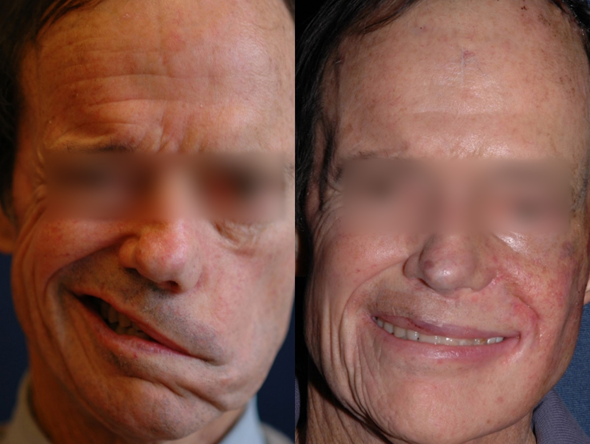 Static Suspension  Before & After Gallery - Patient 365207 - Image 1