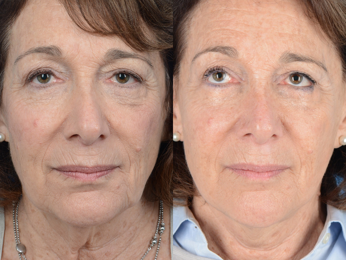 Office Facelift Before & After Gallery - Patient 306835 - Image 1