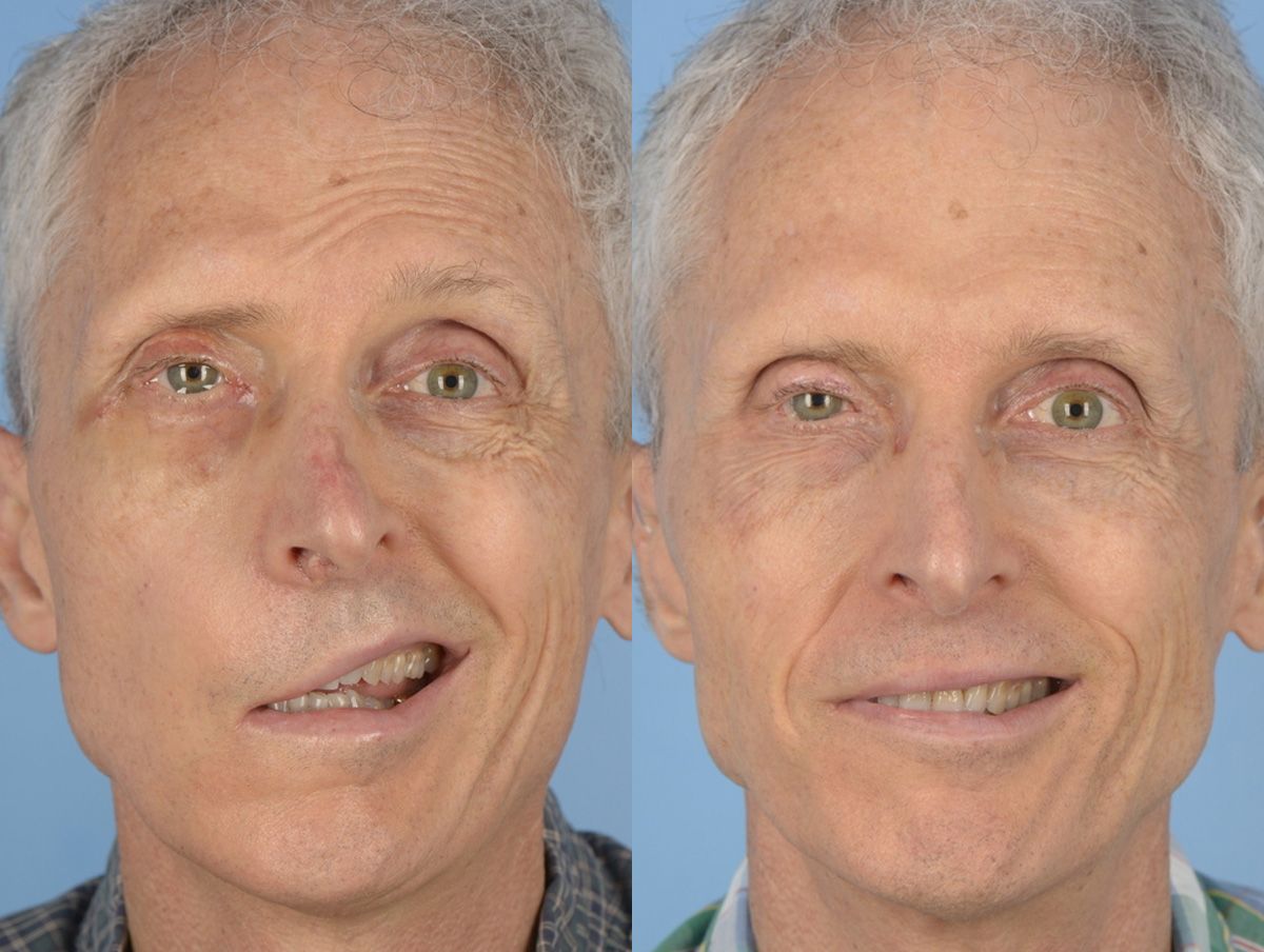 Reinnervation/Nerve Transfers Before & After Gallery - Patient 237217 - Image 1