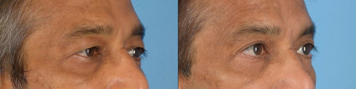 Blepharoplasty Before & After Gallery - Patient 148684 - Image 1