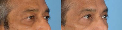 Blepharoplasty Before & After Gallery - Patient 148684 - Image 1
