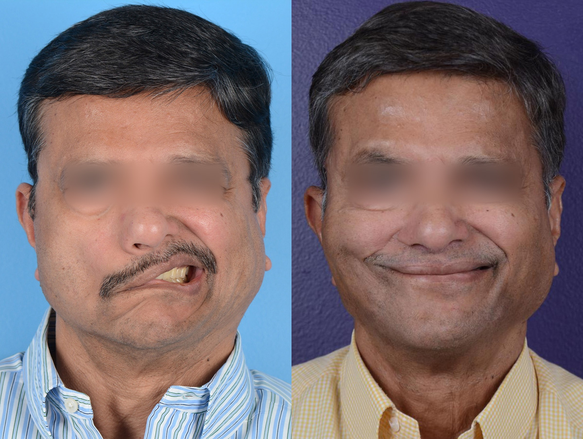 Gracilis Before & After Gallery - Patient 416748 - Image 1