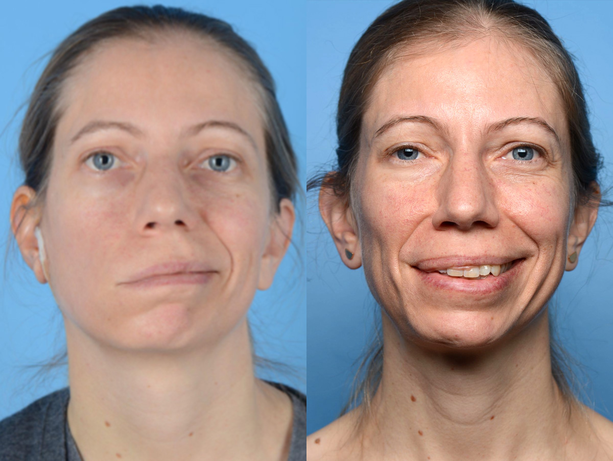 Facial Nerve Repair Before & After Gallery - Patient 427027 - Image 1