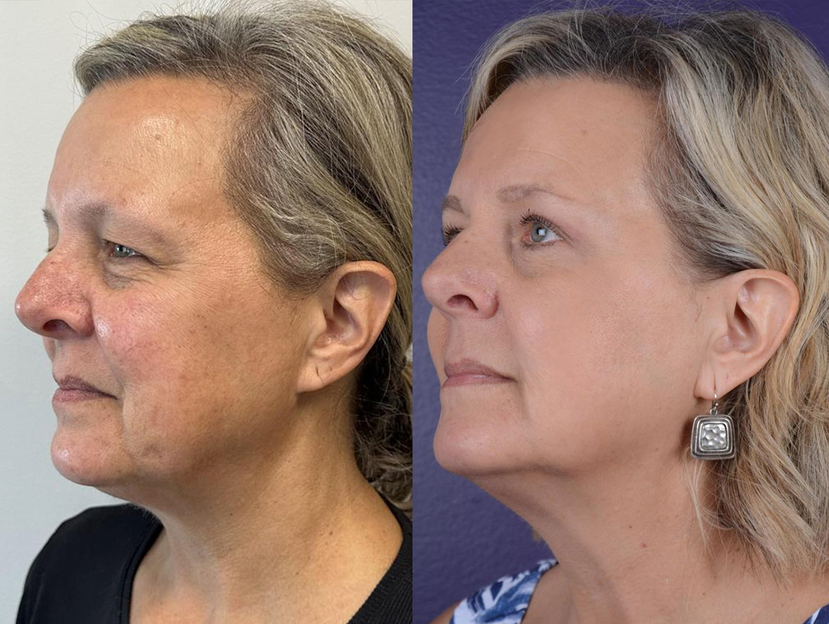 Blepharoplasty Before & After Gallery - Patient 185450 - Image 1