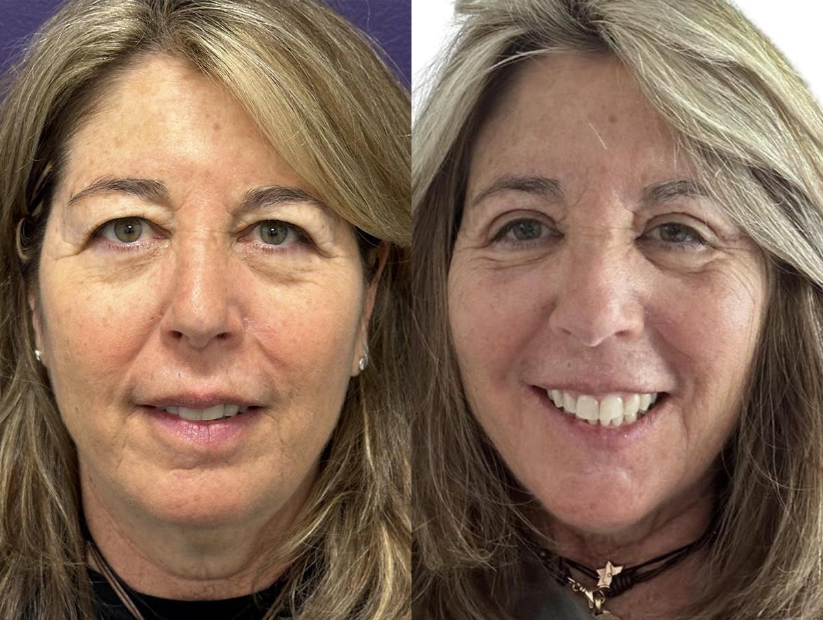Blepharoplasty Before & After Gallery - Patient 273508 - Image 1