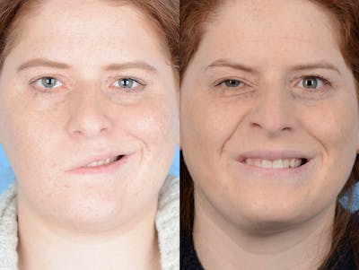 Reinnervation/Nerve Transfers Before & After Gallery - Patient 195657 - Image 1