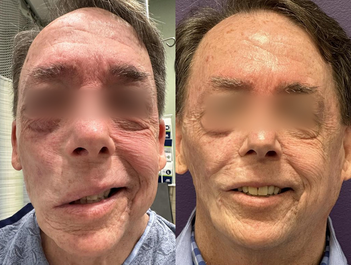 Gracilis Before & After Gallery - Patient 362291 - Image 1