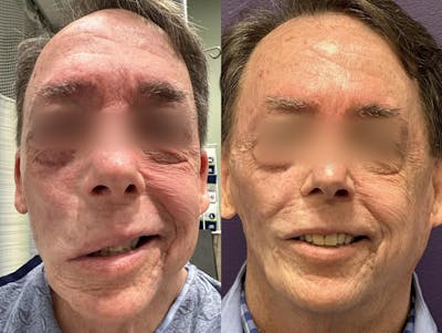 Gracilis Before & After Gallery - Patient 362291 - Image 1