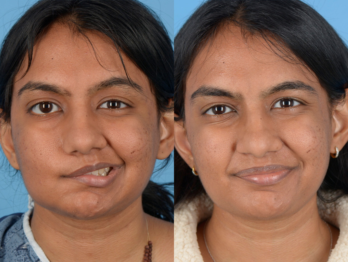 Reinnervation/Nerve Transfers Before & After Gallery - Patient 120629 - Image 1