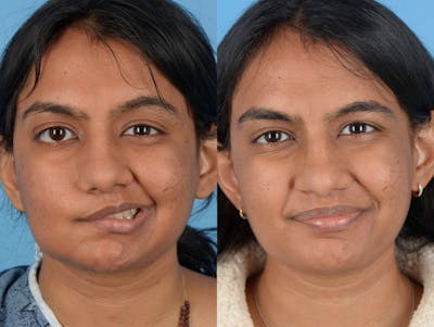 Reinnervation/Nerve Transfers Before & After Gallery - Patient 120629 - Image 1