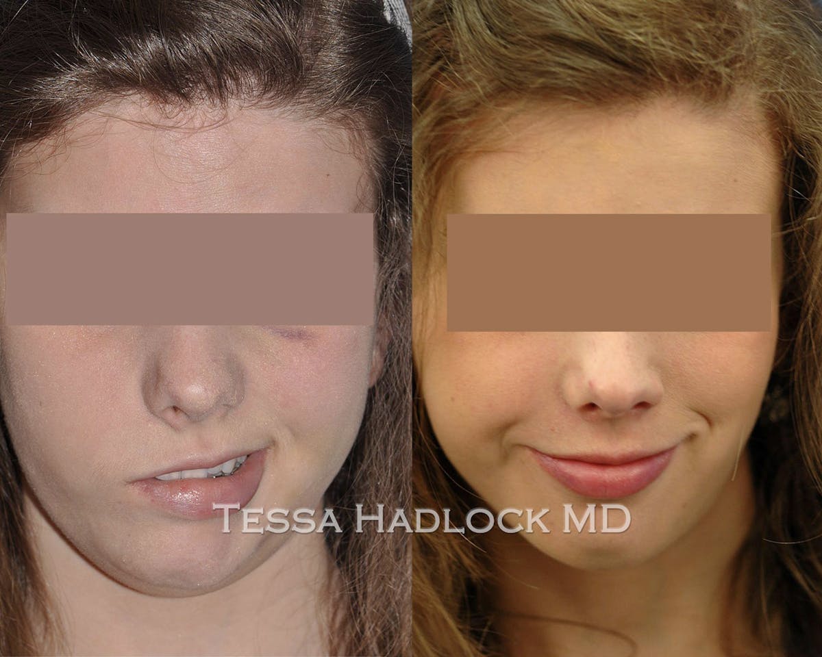 Gracilis Before & After Gallery - Patient 133700 - Image 1