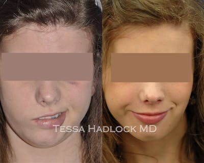 Gracilis Before & After Gallery - Patient 133700 - Image 1