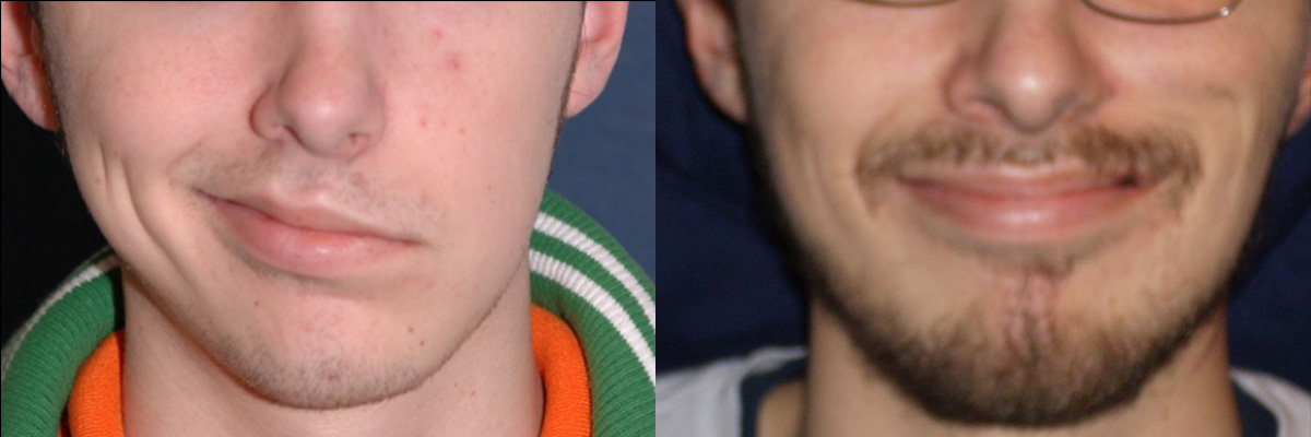 Gracilis Before & After Gallery - Patient 234362 - Image 1