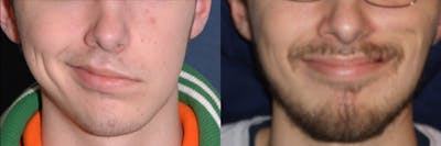 Gracilis Before & After Gallery - Patient 234362 - Image 1