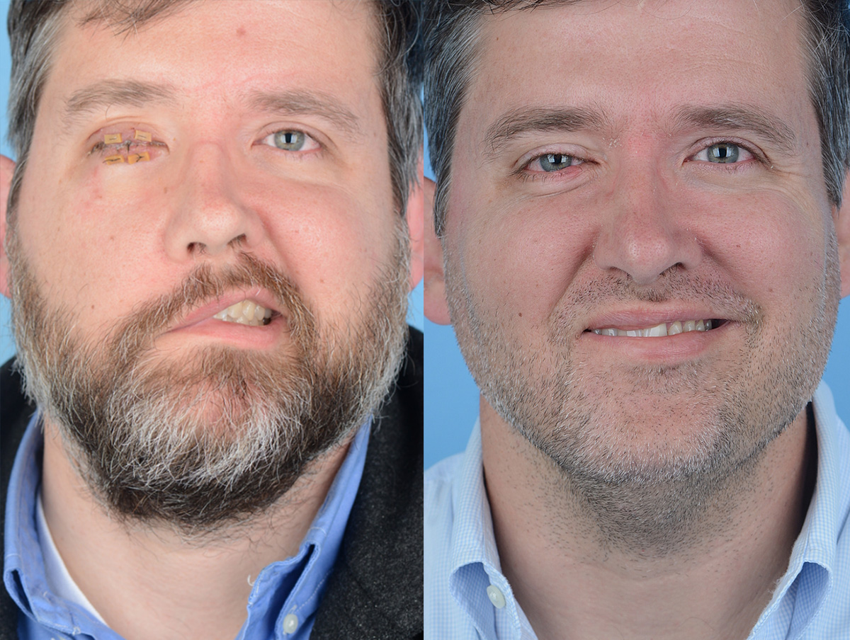 Reinnervation/Nerve Transfers Before & After Gallery - Patient 106578 - Image 1