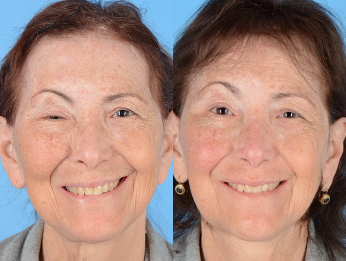 Muscle Resection: DAO, DLI, Ocular Myomectomy, Mentalis Before & After Gallery - Patient 365367 - Image 1