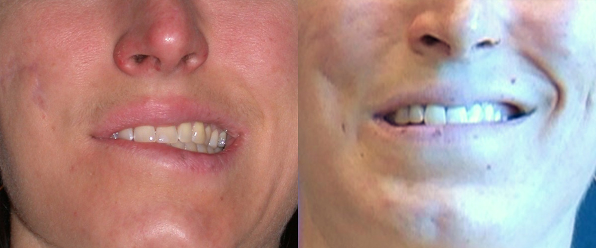 Muscle Resection: DAO, DLI, Ocular Myomectomy, Mentalis Before & After Gallery - Patient 415094 - Image 1