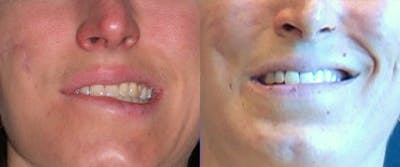 Muscle Resection: DAO, DLI, Ocular Myomectomy, Mentalis Before & After Gallery - Patient 415094 - Image 1