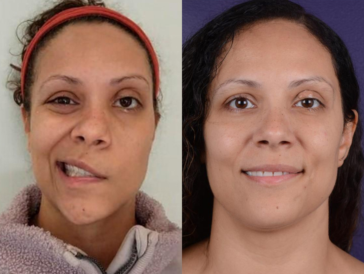 Facial Nerve Repair Before & After Gallery - Patient 361625 - Image 1