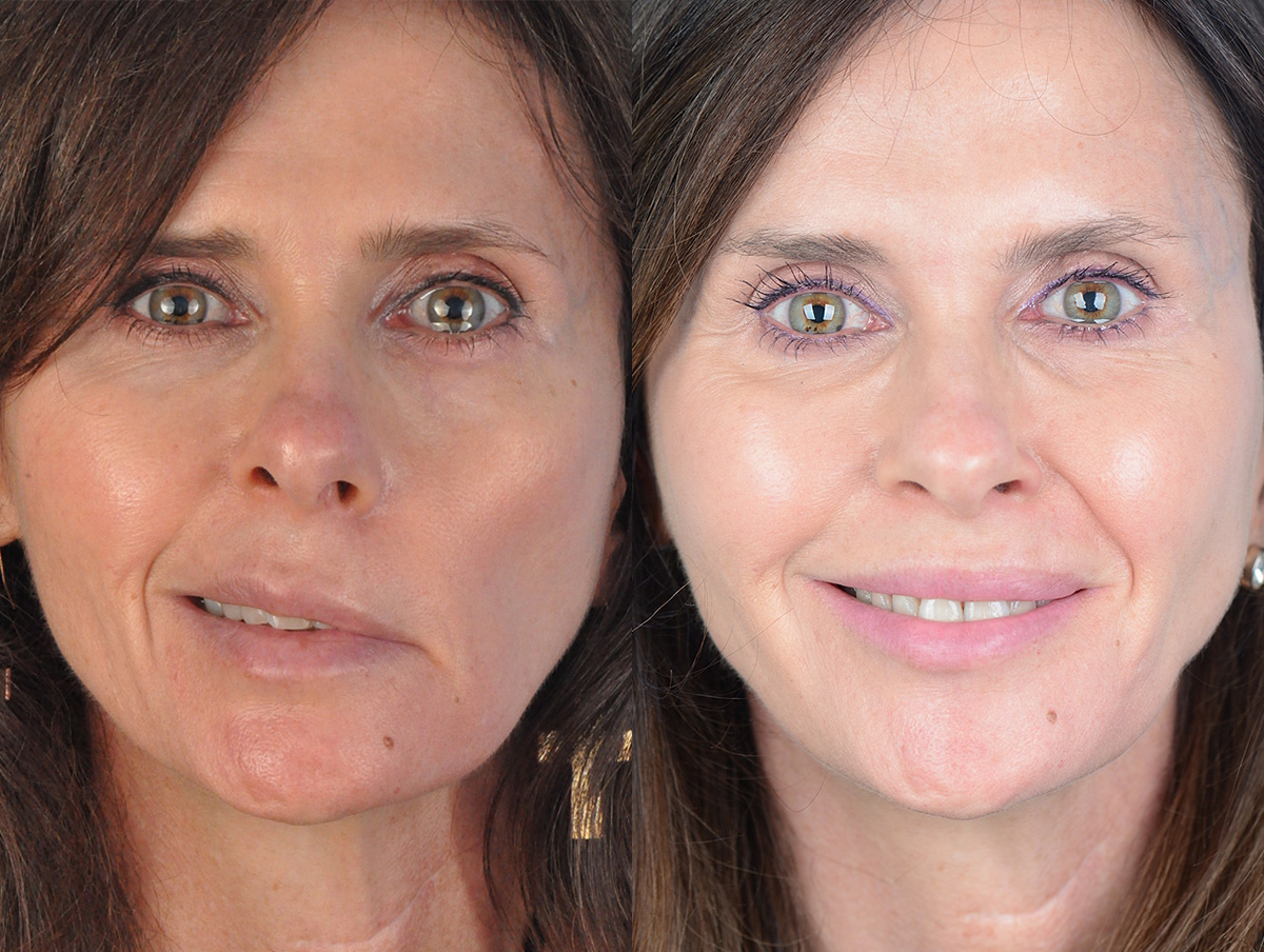 Reinnervation/Nerve Transfers Before & After Gallery - Patient 101004 - Image 1