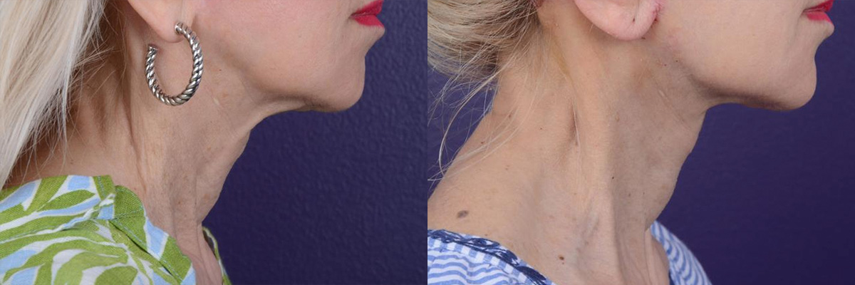 Office Facelift Before & After Gallery - Patient 231761 - Image 1