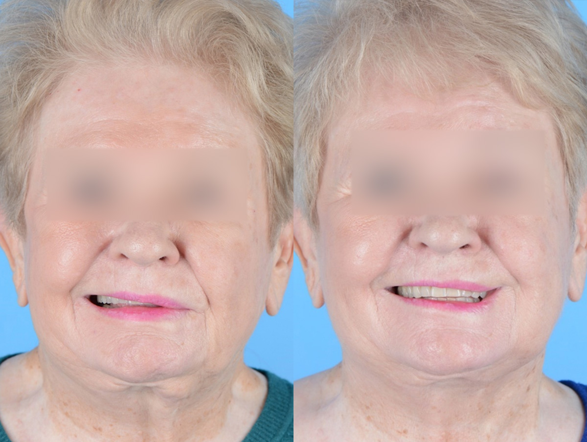 Denervation Before & After Gallery - Patient 288817 - Image 1