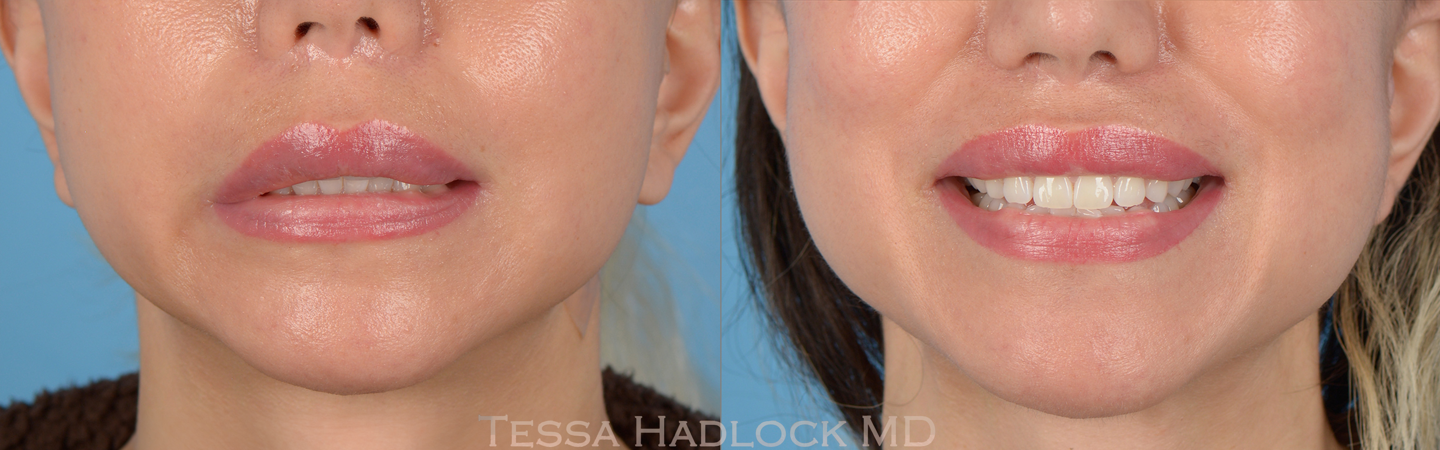 Facial Nerve Repair Before & After Gallery - Patient 782806 - Image 1